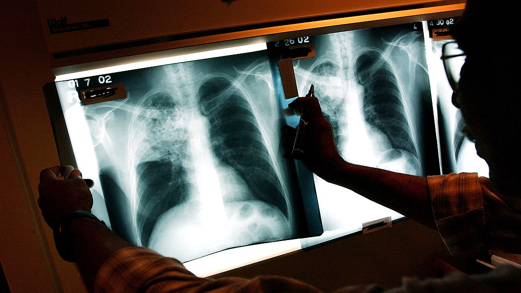 2 active tuberculosis cases traced to San Francisco strip club — KTVU FOX 2 Bay Area, Sonoma Health news